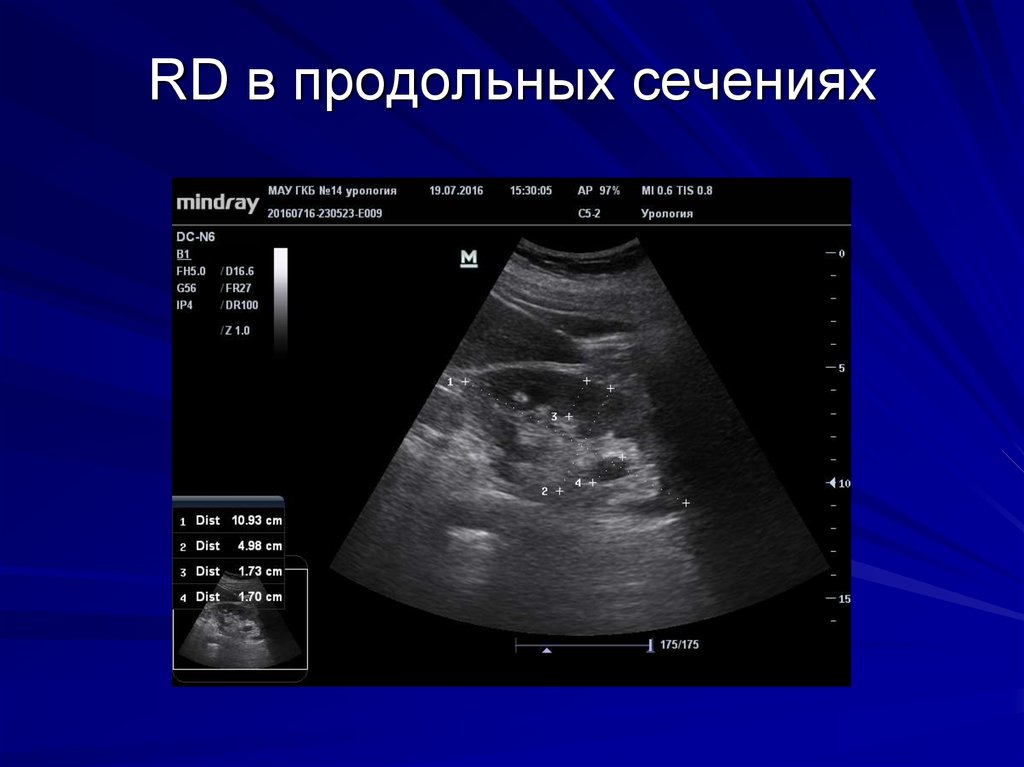 RD в продольных сечениях