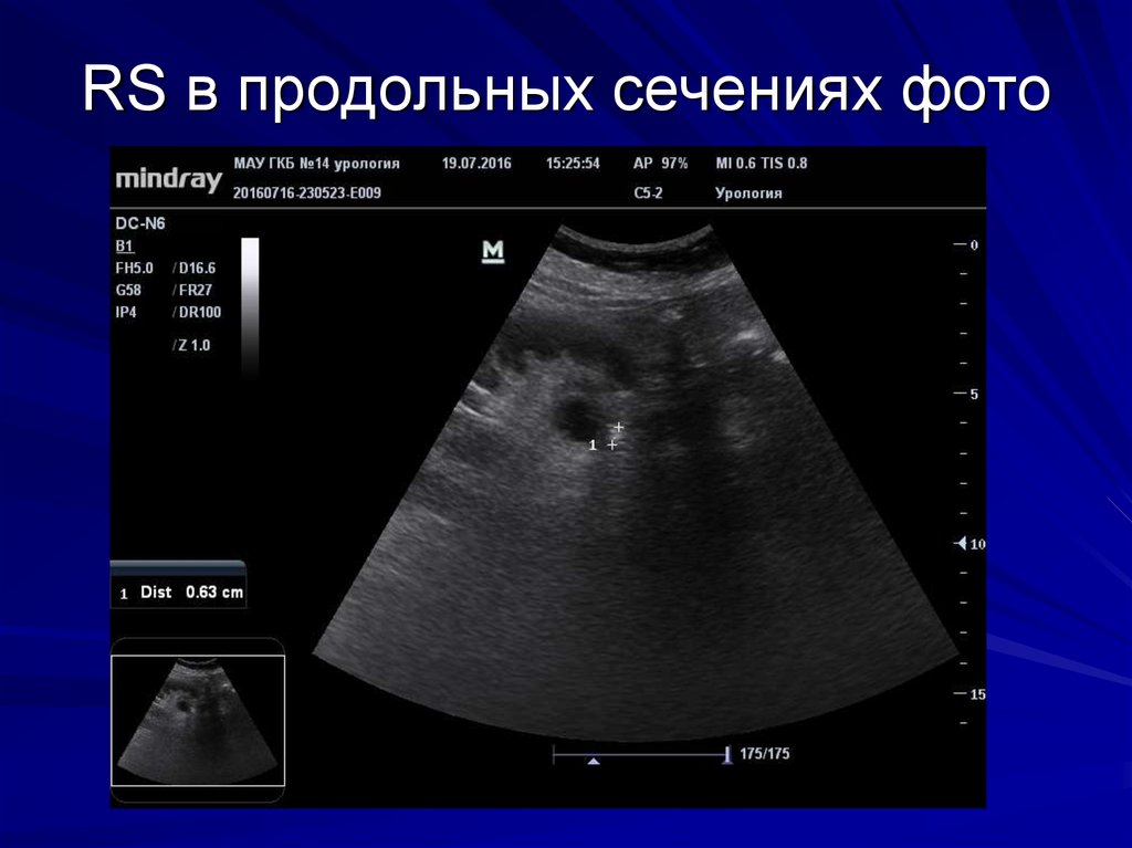 RS в продольных сечениях фото