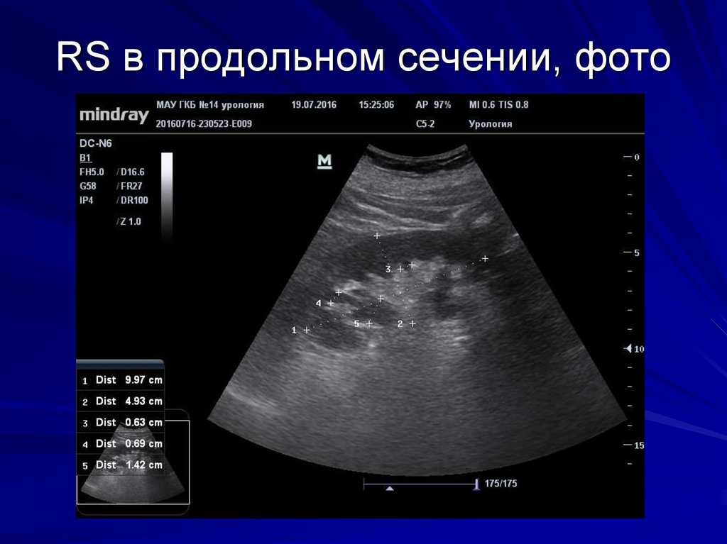 RS в продольном сечении, фото