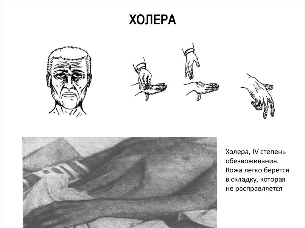 При холере ответ. Холера 4 степень обезвоживания. Клинические симптомы холеры. Клинические проявления легкой формы холеры. Клиника холеры степени обезвоживания.