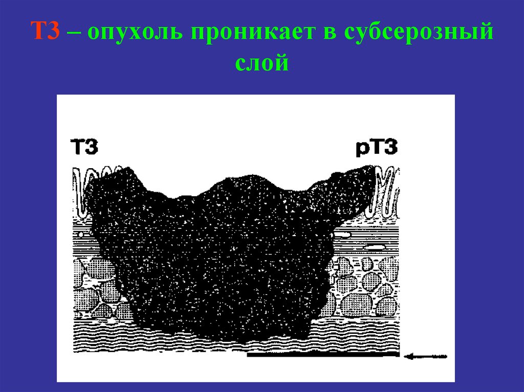 Т3 – опухоль проникает в субсерозный слой