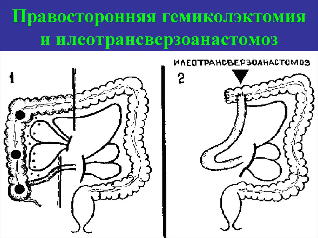 Правосторонняя гемиколэктомия и илеотрансверзоанастомоз