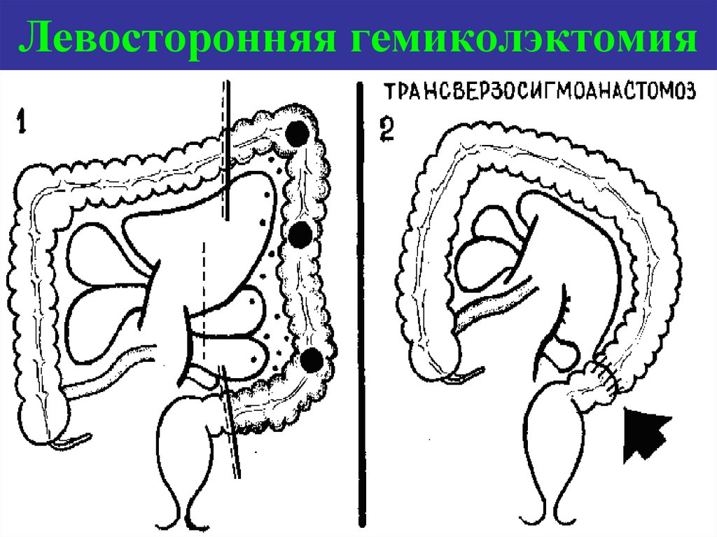 Операция лахея схема