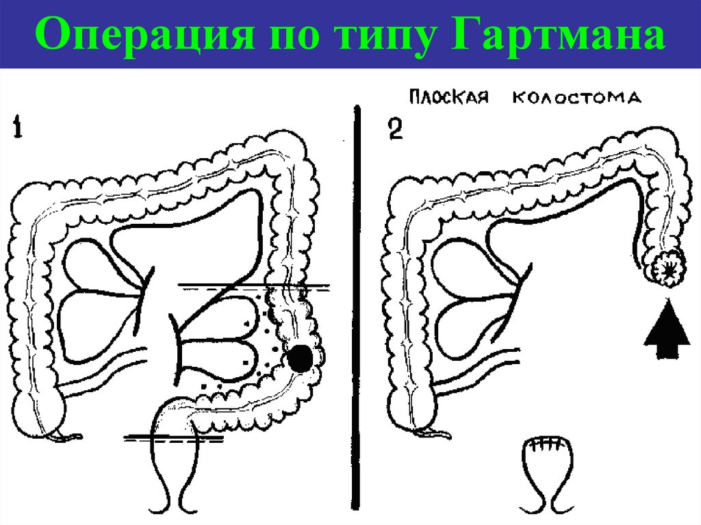 Схема операция гартмана