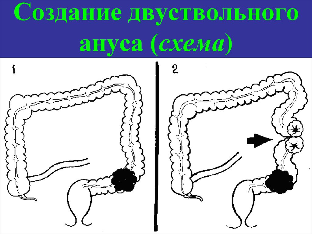 Что такое колостома фото