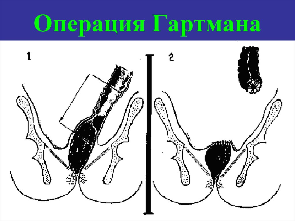 Схема операция гартмана