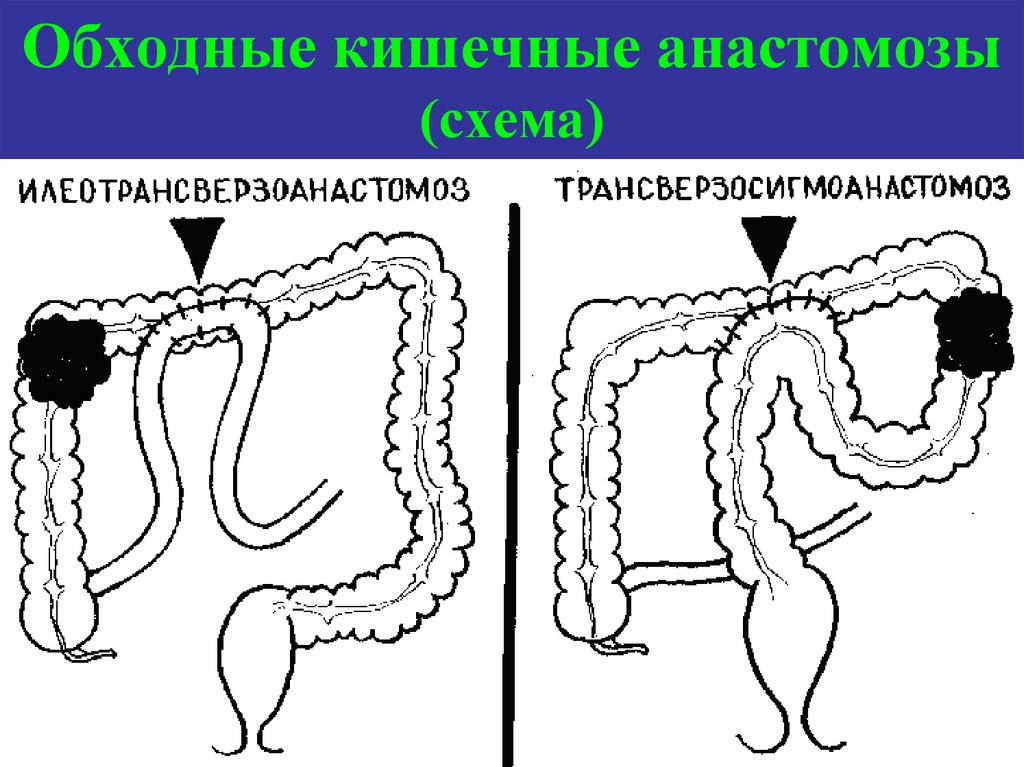 Анастомоз конец в конец схема