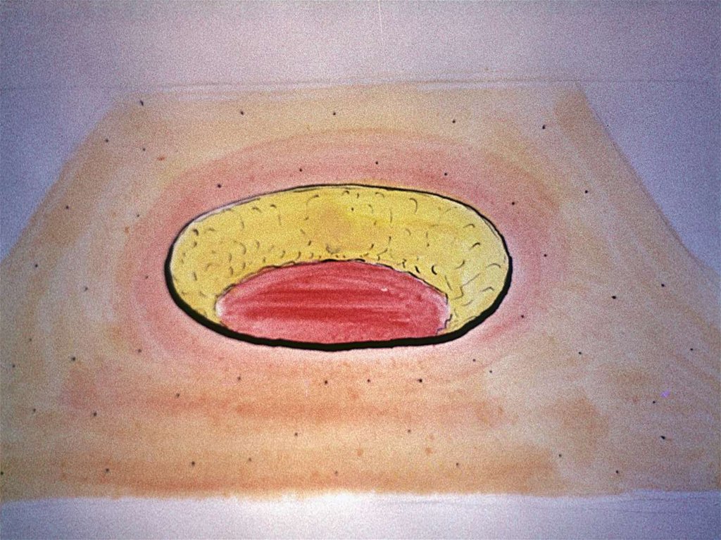 Обходные кишечные анастомозы (схема)