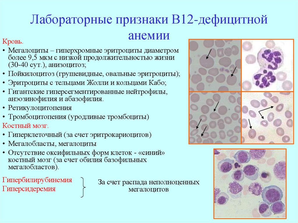 Заболевание б 12. Эритроциты при в 12 анемии. Анализ крови при анемии в12 дефицитной анемии. В12 дефицитная анемия анализ крови показатели. В12 фолиеводефицитная анемия анализ.