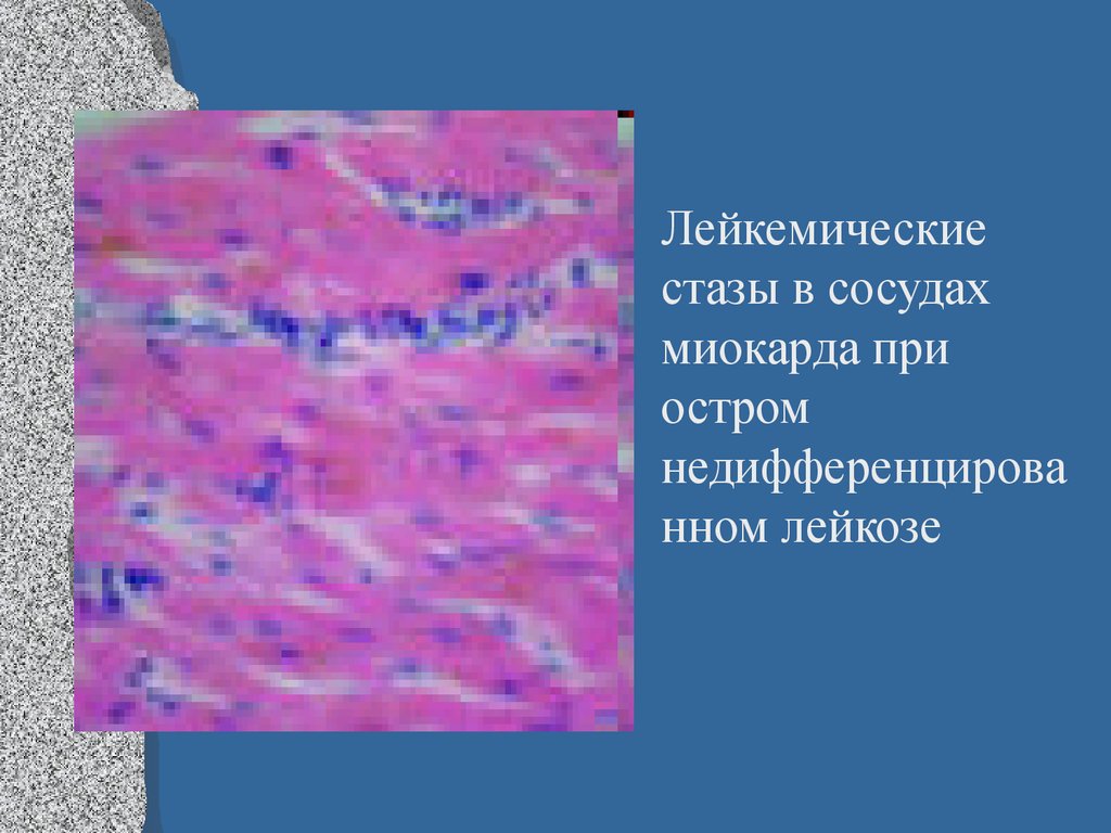 Селезенка при лейкозе. Лейкемическая инфильтрация миокарда. Лейкозные инфильтраты при остром лейкозе. Острый лейкоз селезенки.