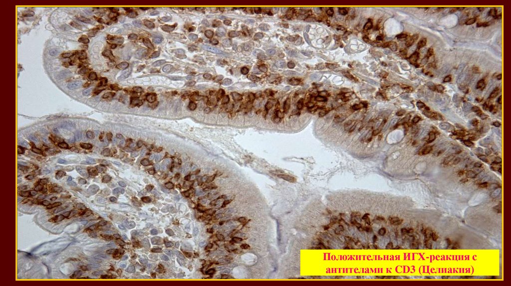 Иммуногистохимия эндометрия. Целиакия гистология кишечника. Целиакия микропрепарат ИГХ реакция с cd3. Целиакия микропрепарат.