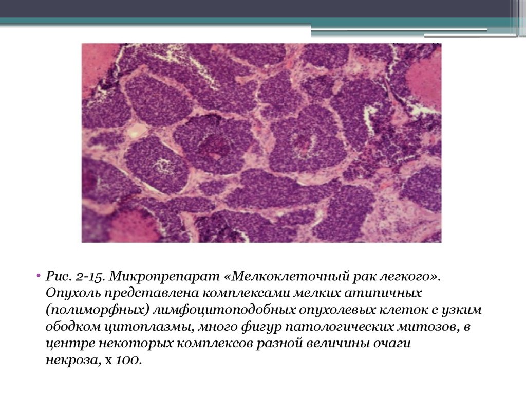 Описание микропрепарата. Карцинома легкого микропрепарат. Опухоль легкого макропрепарат. Мелкоклеточная карцинома микропрепарат. Плоскоклеточная карцинома легкого гистология.