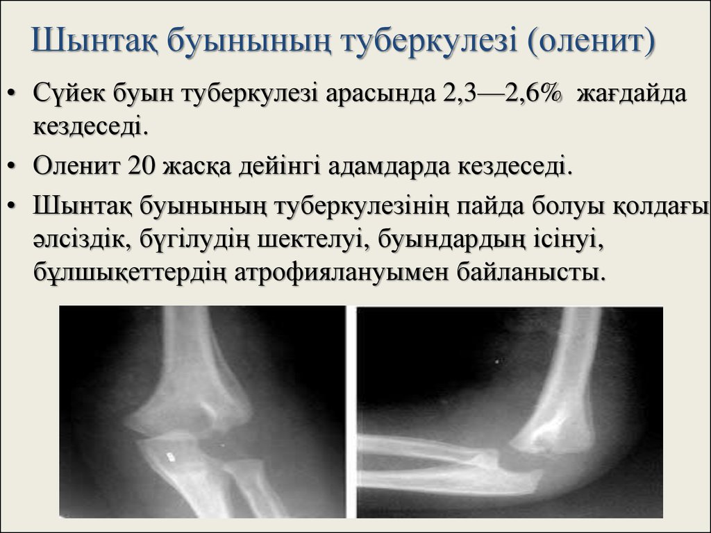 Буын синдромы презентация