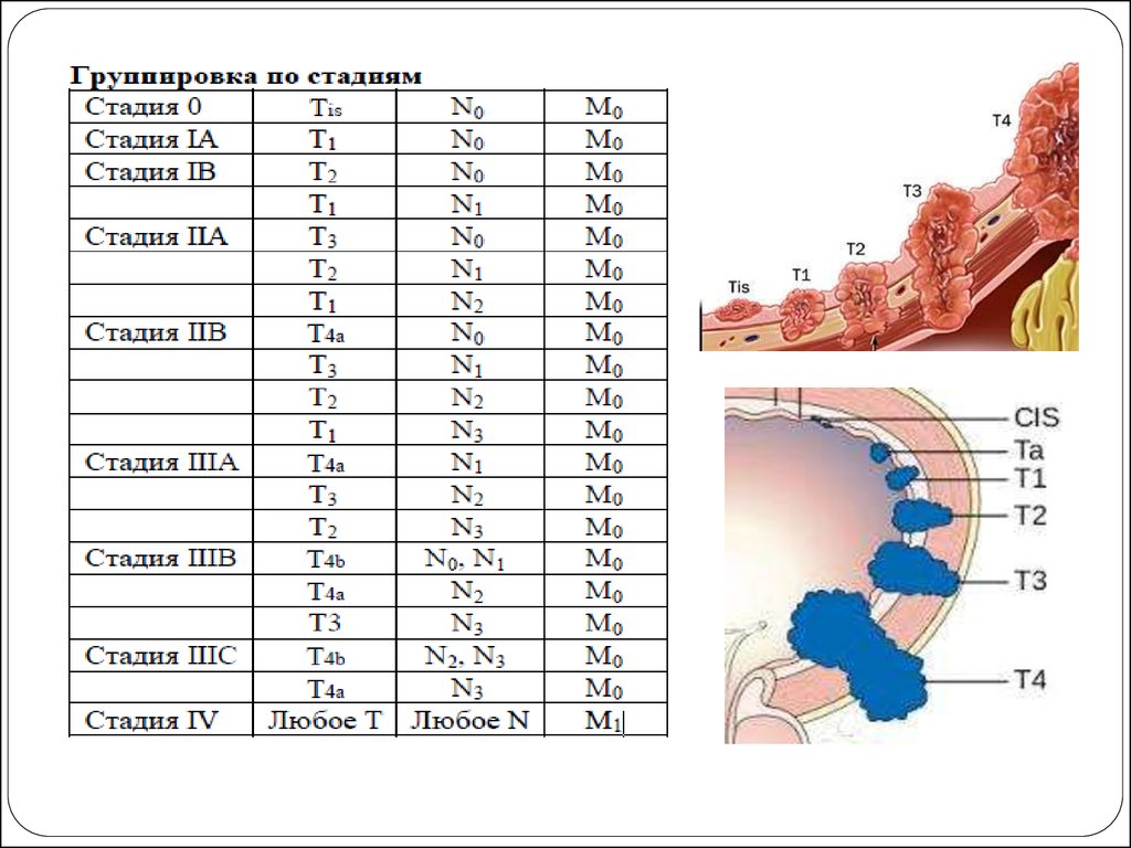 Рак желудка план ухода