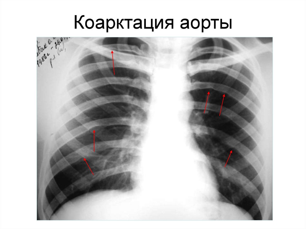 Коарктация аорты картинки