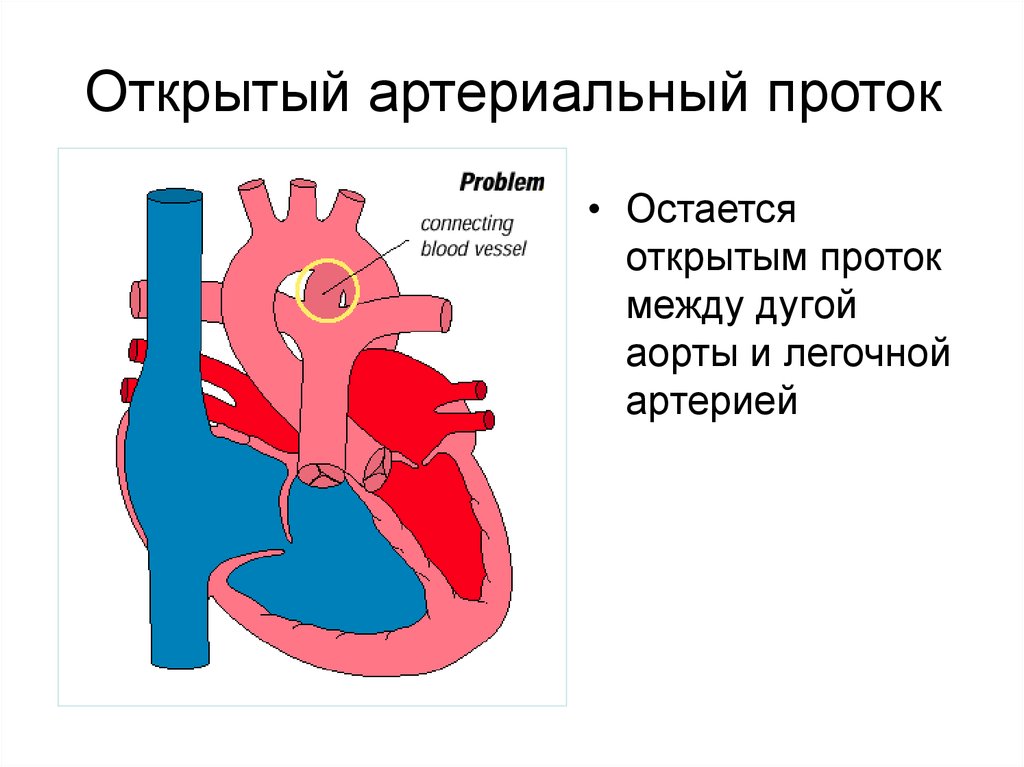 Оап у новорожденных. Открытый артериальный (боталлов) проток (ОАП). Открытый (персистирующий) артериальный проток. Артериальная связка боталлов проток. Артериальный боталлов проток соединяет.