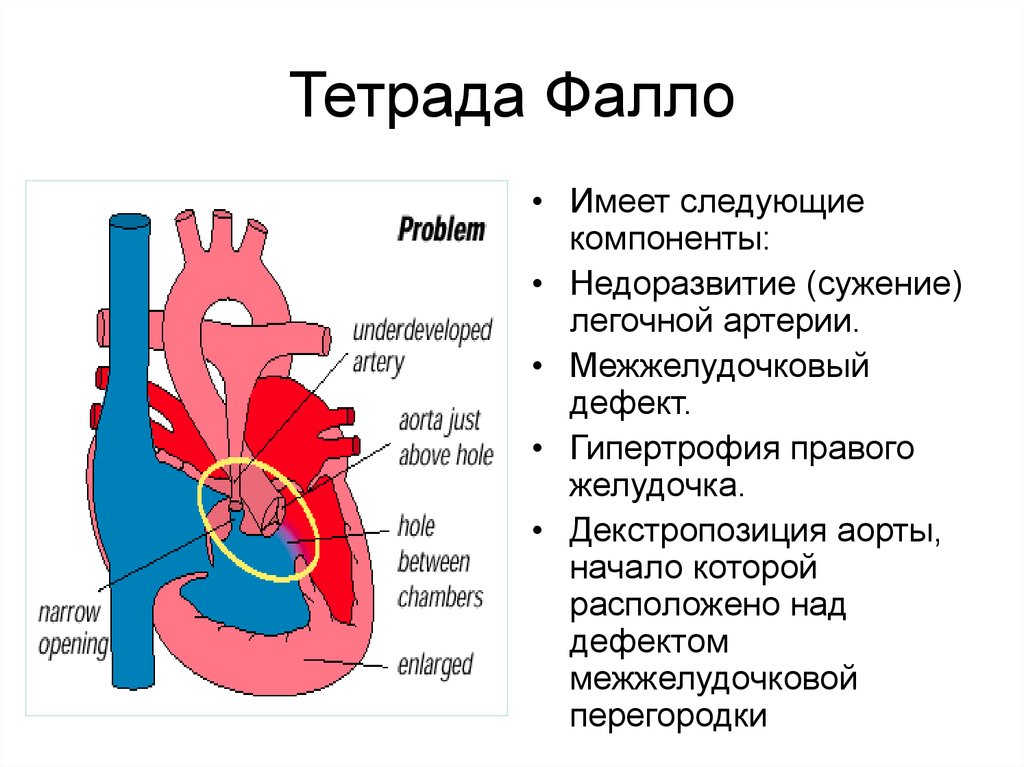 Тетрада фалло это. Врожденный порок сердца Тетрада Фалло у детей. Врожденные пороки сердца болезнь Фалло. Клинические симптомы тетрады Фалло. Тетрада Фалло это врожденный порок сердца.