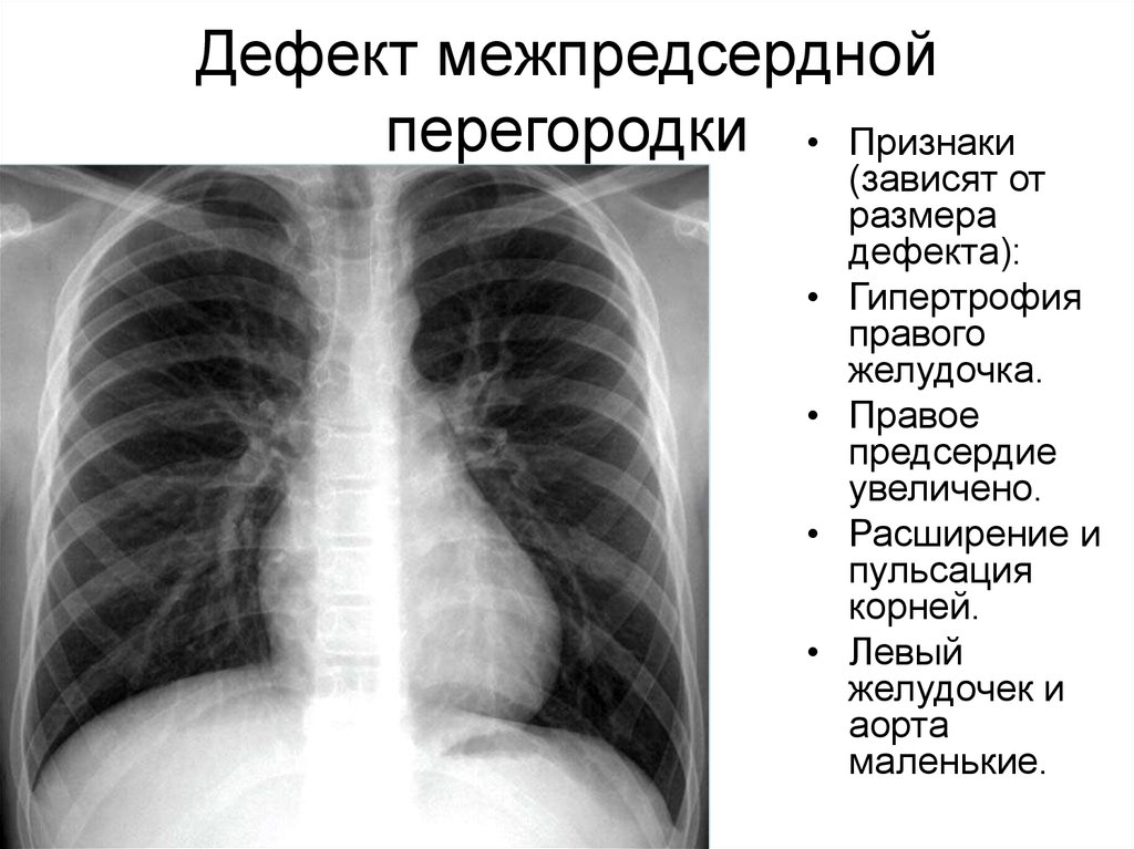 Дефект межпредсердной. Дефект прдсердной перегородки. Фефект предсердной перегородки. Дефект межпредсердной перегородки симптомы. Дефектк межпредсерднойой перегородкит.