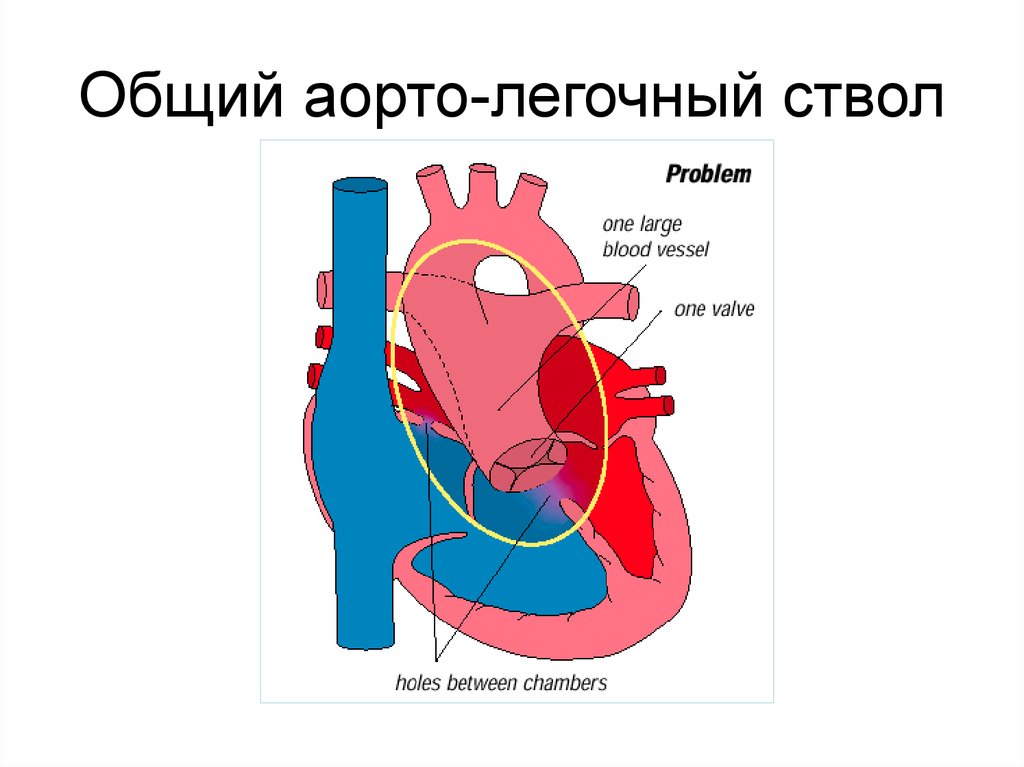 Легочный ствол рисунок