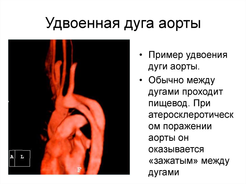 Дуга аорты. Атероматозное изменение дуги аорты. Тень дуги аорты. Удвоение дуги аорты кт.