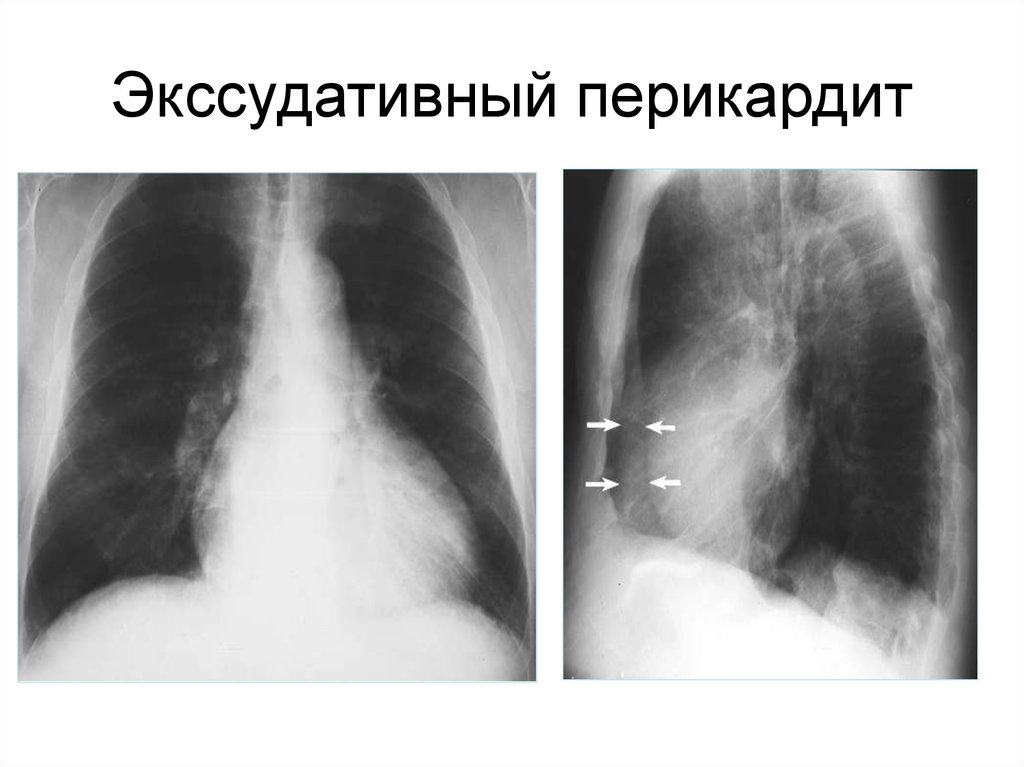 Перикардит. Слипчивый перикардит рентген. Констриктивный перикардит рентген. Экссудативный перикардит рентгенограмма. Экссудативный перикардит.