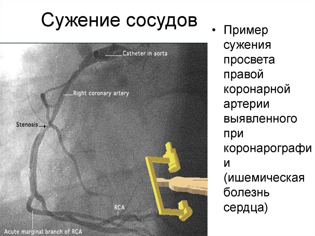 Причины сужения сосудов головного. Сужение просвета артерии. Сужение артерий причины.