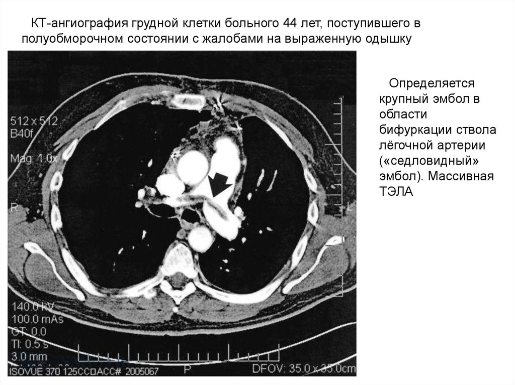 Кт клетки. Тэла спиральная компьютерная томография. Тромбоз легочной артерии на кт. Тромбоэмболия легочной артерии на кт.