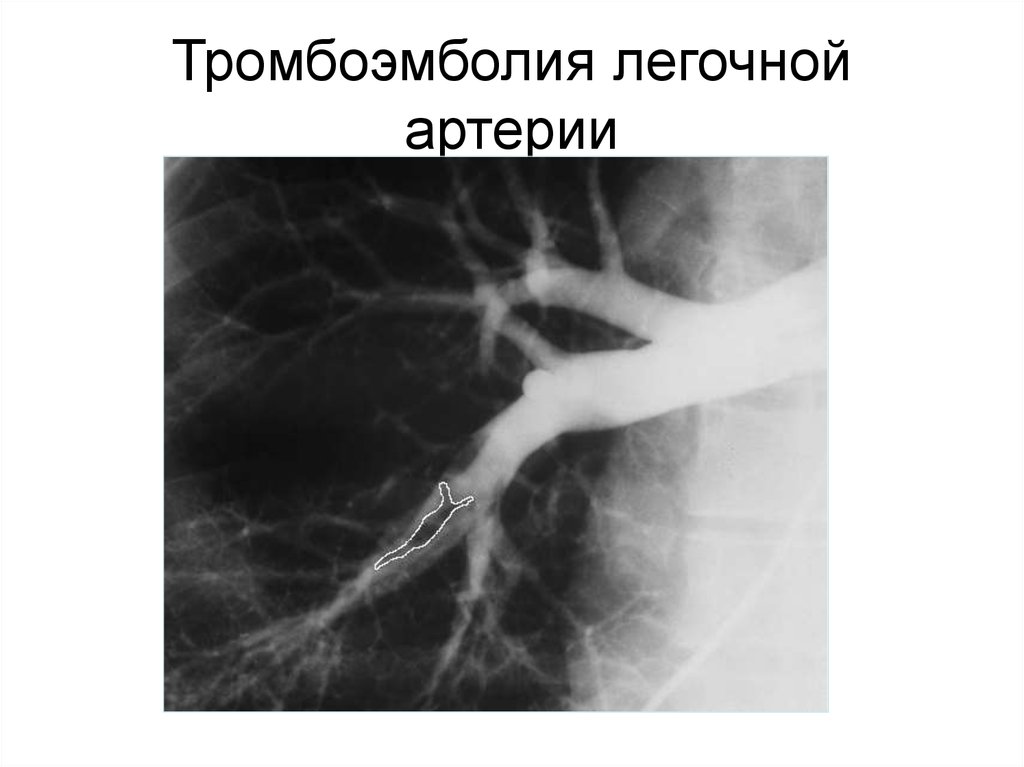 Тромбоэмболия сердечная. Тромб в легочной артерии. Рентгенодиагностика тромбоэмболии легочной артерии. Рентгенодиагностика Тэла. Тромбоэмболия легочной артерии лучевая диагностика.