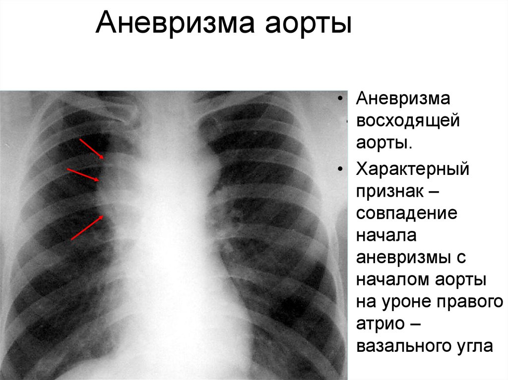 Аневризма аорты симптомы. Расслоение аневризмы аорты на рентгене. Аневризма сердца рентген. Аневризма восходящей аорты. Аневризма грудной аорты лучевая диагностика.