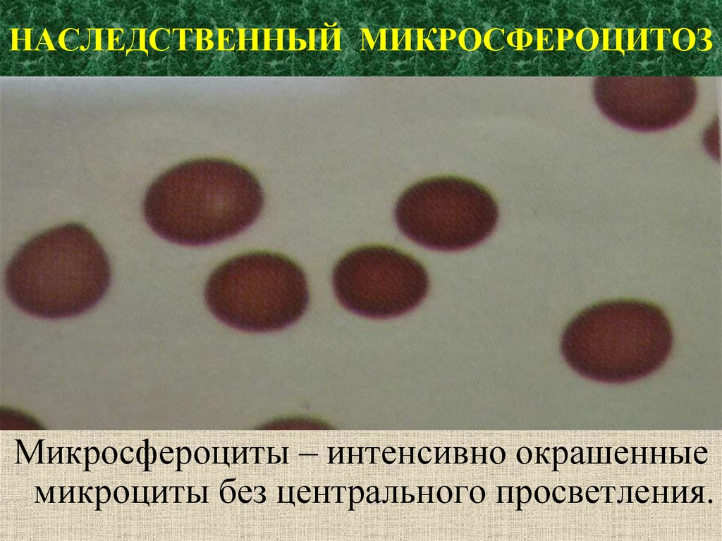 Микросфероцитоз анемия. Наследственный микросфероцитоз. Наследственный сфероцитоз патогенез. Микросфероциты в крови.