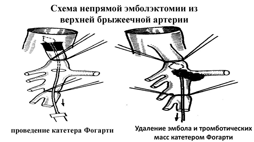 Схема операции удаления эмбола из бифуркации аорты