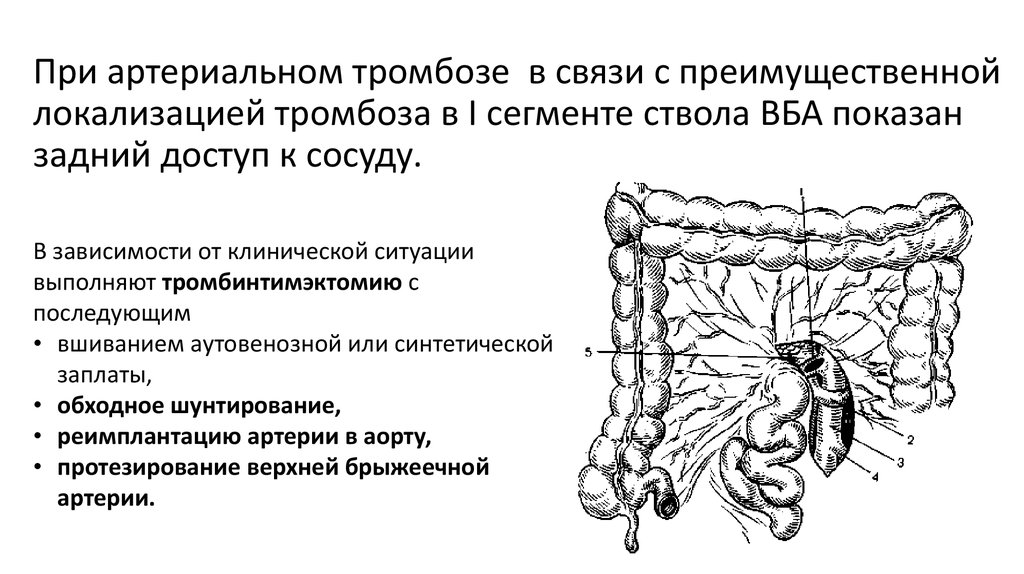Мезентериальный тромбоз код мкб. Мезентериальные лимфатические узлы УЗИ. Сегменты верхней брыжеечной артерии. Шунтирование брыжеечной артерии.