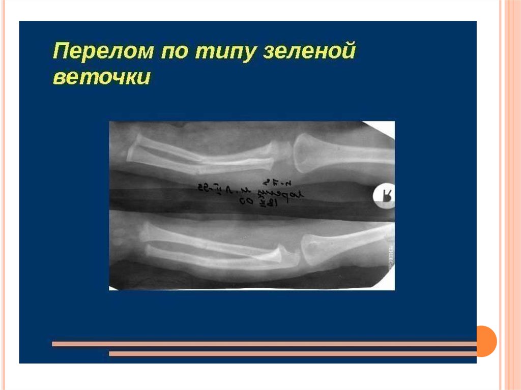 Балалардағы сынықтардың ерекшелігі - презентация онлайн
