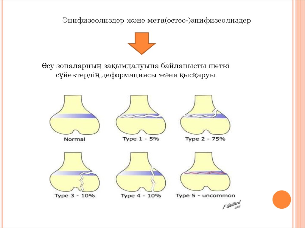Балалардағы сынықтардың ерекшелігі - презентация онлайн