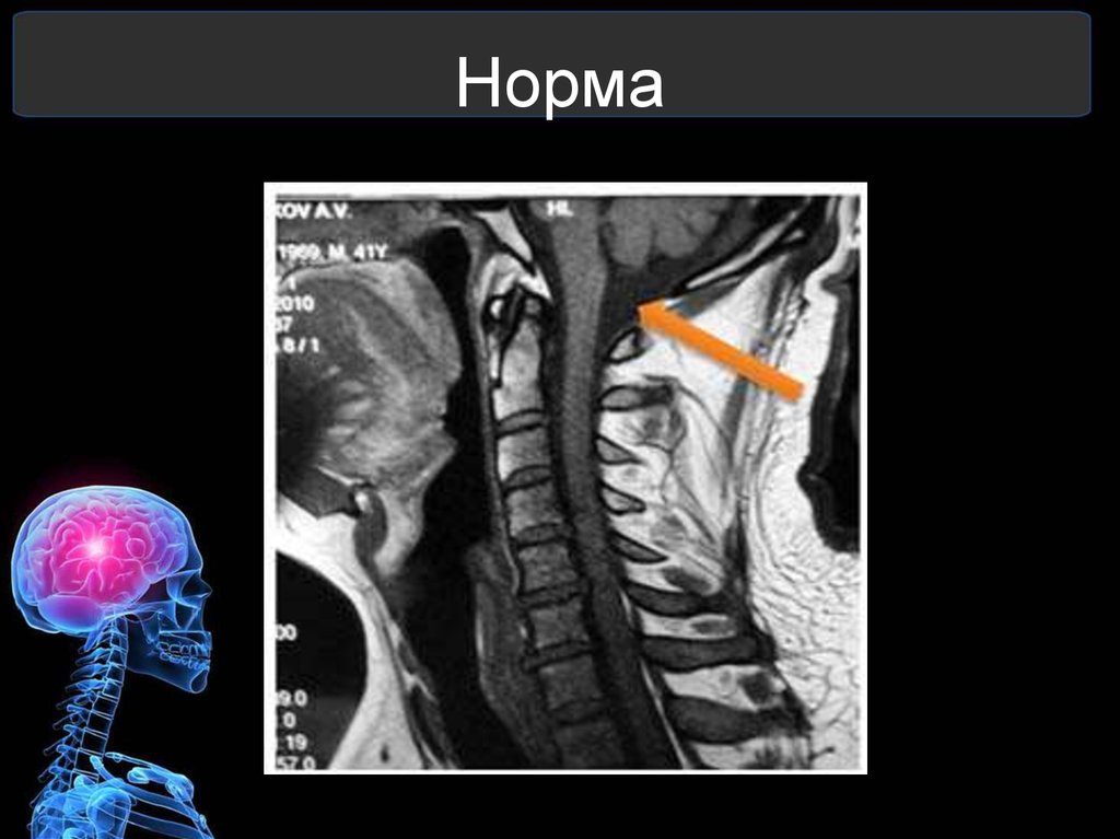 Мр картина аномалии арнольда киари