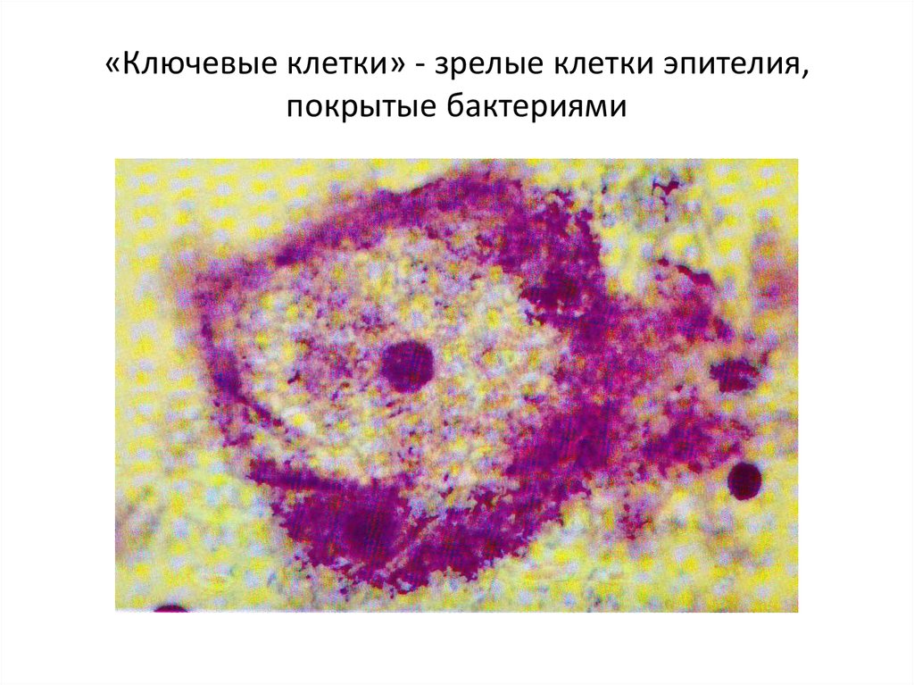 Баквагиноз что это. Бактериальный вагиноз ключевые клетки. Бактериальный вагиноз мазок микроскопия. Ключевые клетки при бактериальном вагинозе. Ключевая клетка в гинекологическом мазке.