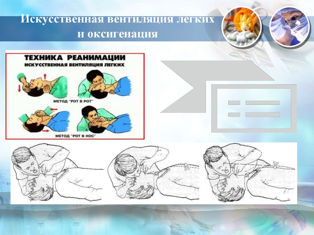 Признаки эффективности реанимационных мероприятий тест