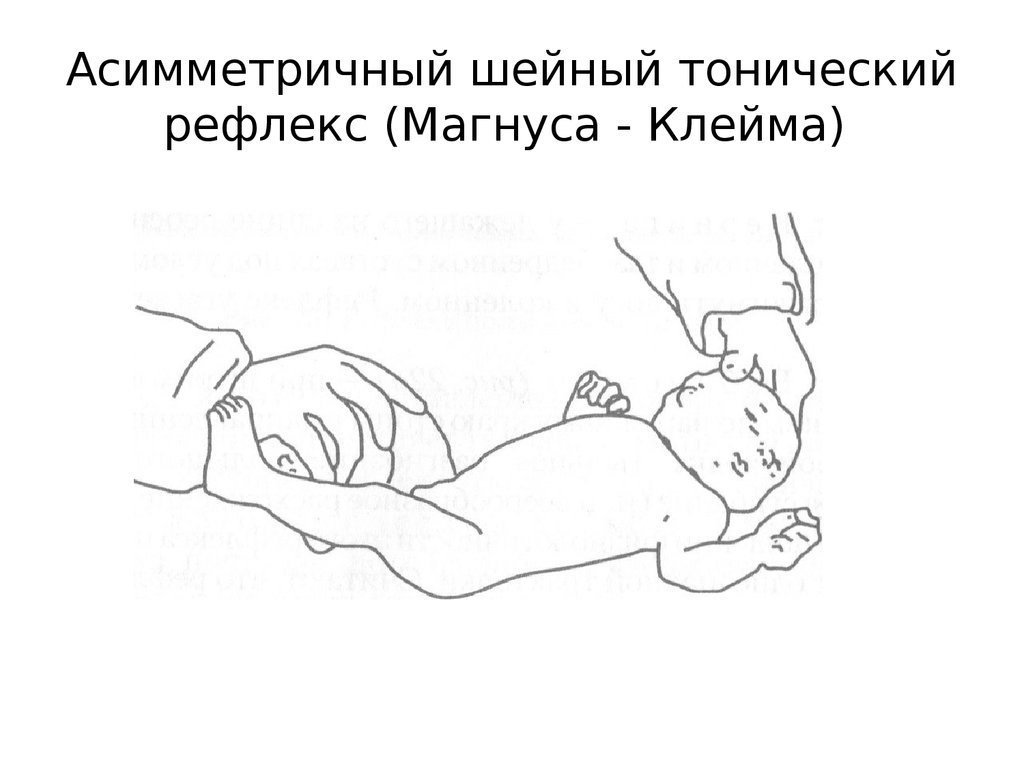 Рефлекс паралича. Шейно тонический рефлекс новорожденных. Асимметричный шейный тонический рефлекс у новорожденных. Симметричный шейный тонический рефлекс (СШТР). Лабиринтный тонический рефлекс.