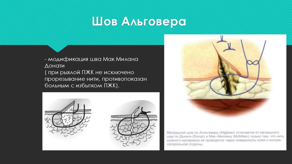 Жидкость шов. Шов Донати модификация Альговера. Шов Мак-Миллана –Донати. Вертикальный матрацный шов по Альговеру. Снятие швов по Альговеру.