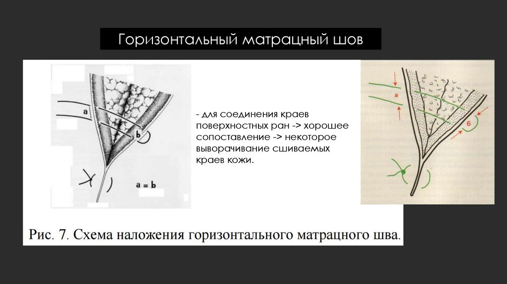 Горизонтальный шов. Горизонтальный и вертикальный матрацный шов. Узловой горизонтальный матрацный шов. Непрерывный горизонтальный матрацный шов. Односторонний матрацный шов.