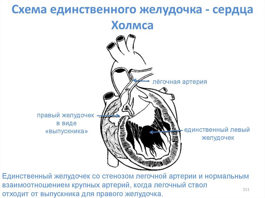 В правый желудочек сердца человека поступает. ВПС единственный желудочек. Единый желудочек сердца порок. Двуприточный левый желудочек единственный. Единственный желудочек сердца операция Фонтена.