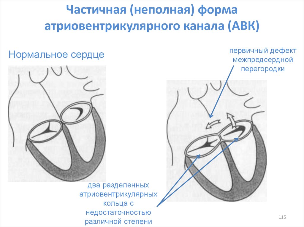 Открытый атриовентрикулярный канал презентация