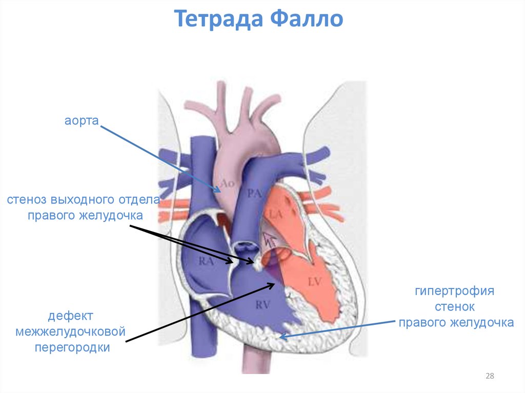 Тетрада фалло это. Врожденные пороки сердца болезнь Фалло. Гемодинамика при тетраде Фалло схема. Врожденные пороки сердца гемодинамика Тетрада Фалло. Нарушение гемодинамики при тетраде Фалло.