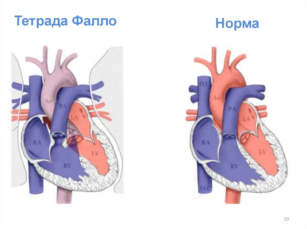 Врожденный порок сердца тетрада фалло презентация