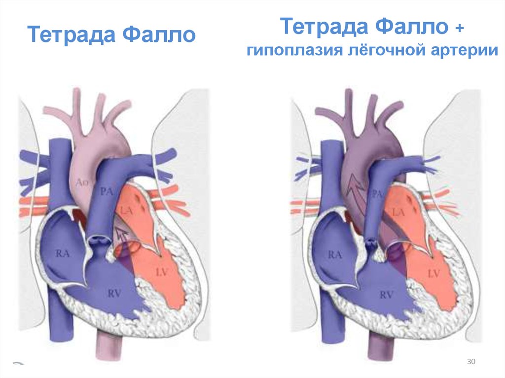 Тетрада фалло клинические