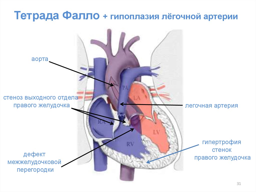 Стеноз легочной артерии. Гипоплазия легочной артерии на кт. Тетрада Фалло с агенезией клапана легочной артерии. Стеноз выходного отдела правого желудочка. Гипоплазия легочной артерии рентген.