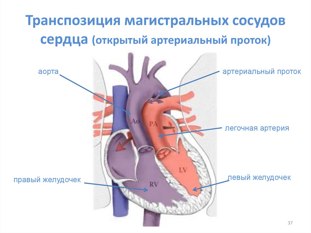 Транспозиция артерий