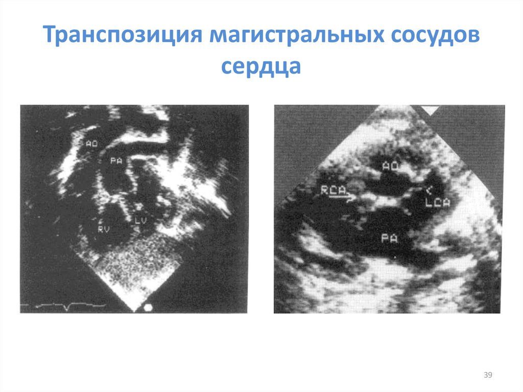 Транспозиция артерий