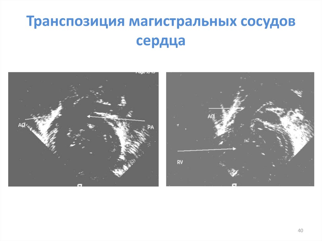 Транспозиция артерий