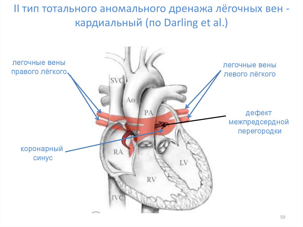 Аномальный дренаж легочных вен